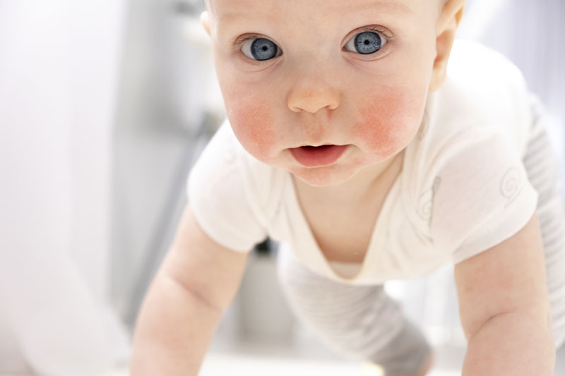 La alergia a la proteína de la leche en bebés