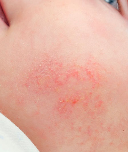 prevenir irritaciones en la piel del bebé
